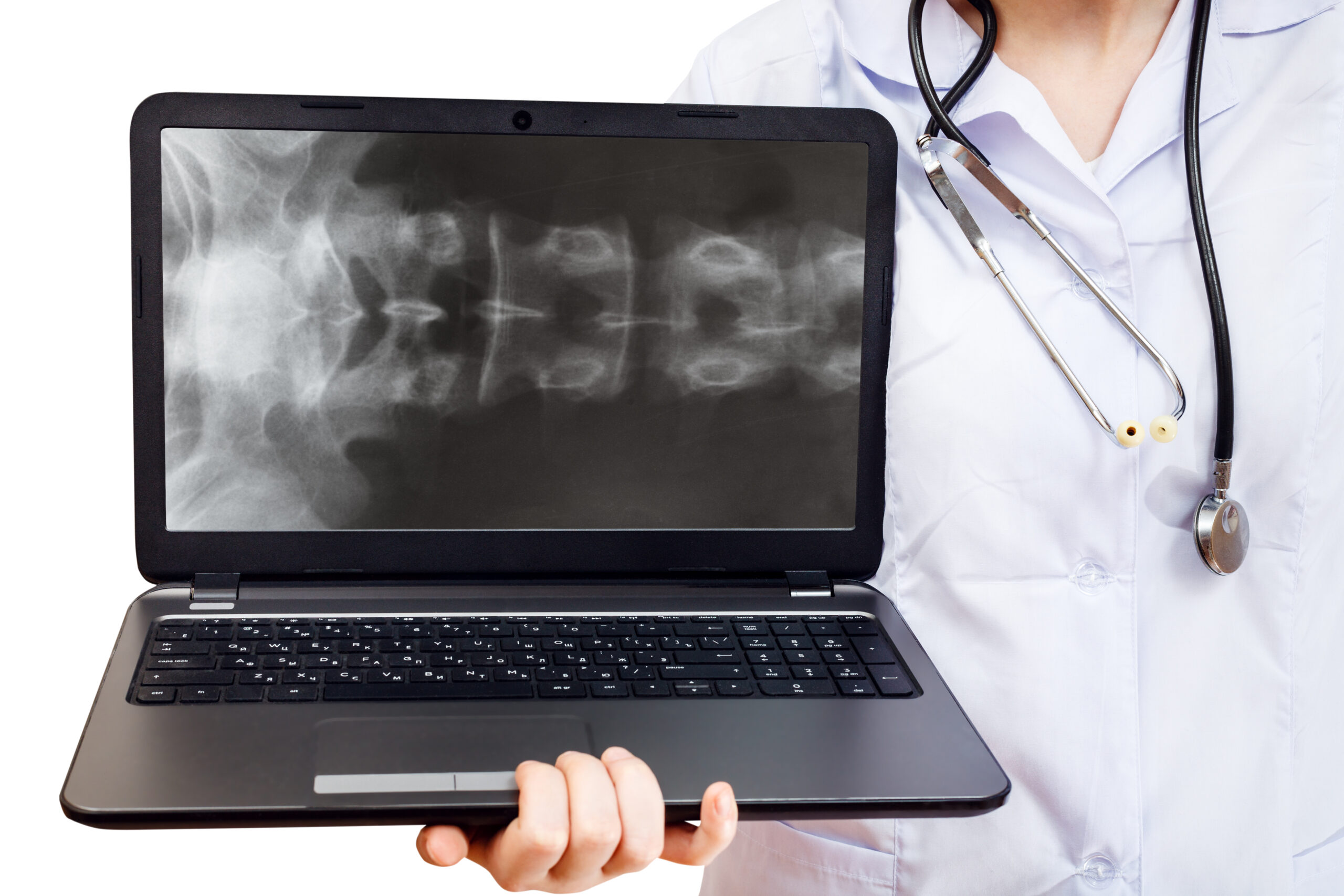 Na zdjęciu widoczne jest zdjęcie rentgenowskie kości, które ukazuje zmiany charakterystyczne dla choroby czarnych kości, zwanej również Alkaptonurią. Zdjęcie to jest prezentowane na ekranie laptopa, co symbolizuje nowoczesne podejście do diagnostyki chorób kości z wykorzystaniem technologii cyfrowych. Dzięki takim narzędziom lekarze mogą dokładniej zdiagnozować choroby kości, takie jak Alkaptonuria, i zaplanować odpowiednie metody leczenia.