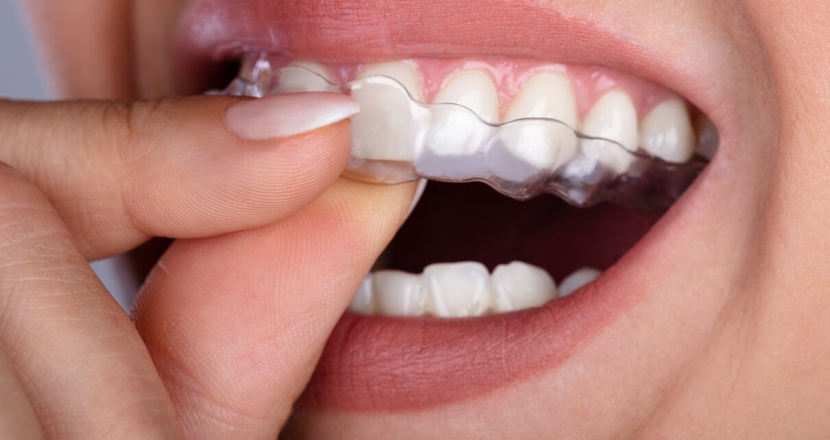 Kobieta z problmem bruksizmu zakąłda na zęby ochronke