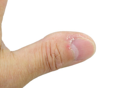 Ten obrazek przedstawia chory paznokieć na kciuku umieszczony na białym tle, co pozwala na dokładne zobrazowanie szczegółów tego schorzenia. Paznokieć wykazuje widoczne oznaki choroby, takie jak zmiana koloru, nieprawidłowa struktura i niejednolity wygląd. Obszar zainfekowanego paznokcia może być wrażliwy lub bolesny przy dotyku. Wizualne przedstawienie tego chorym paznokciem przyciąga uwagę do problemów zdrowotnych związanych z paznokciami i może stanowić motywację do poszukiwania właściwej diagnozy i leczenia.
