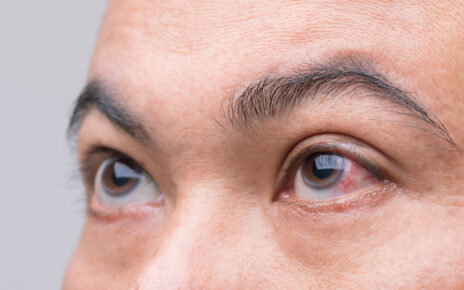 Na zdjęciu widoczne są oczy kobiety z objawami zapalenia oczodołu. Jej oczy są zaczerwienione i opuchnięte, co sugeruje występowanie obrzęku okołooczodołowego. Kolor skóry wokół oczu jest niezdrowy, a kobieta patrzy smutno i z bólem, co podkreśla dyskomfort związany z tą chorobą. Obrazek taki może stanowić przypomnienie, jak ważne jest dbanie o zdrowie oczu i jakie konsekwencje może mieć zaniedbanie w tej kwestii