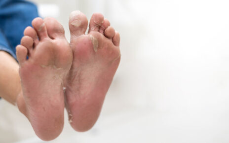 Ten poruszający obrazek przedstawia stopy, na których widoczne jest złuszczanie skóry. Schodząca skóra na stopach może być objawem różnych schorzeń, w tym grzybicy stóp lub suchej skóry. Obrazek ukazuje potrzebę odpowiedniej pielęgnacji i leczenia, aby przywrócić zdrową, gładką skórę stóp i zapewnić komfort podczas chodzenia