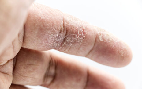 Na obrazku można zobaczyć dłoń pokrytą popękaną skórą, co jest objawem choroby skóry. Widoczne spękania i złuszczanie skóry wskazują na istniejący problem dermatologiczny. Ten obrazek ilustruje potrzebę diagnozowania i leczenia chorób skóry oraz podkreśla znaczenie odpowiedniej pielęgnacji i ochrony skóry dłoni