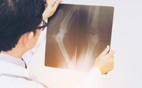 Na zdjęciu rentgenowskim widać chorą kość pacjenta. Zdjęcie ukazuje zmiany zachodzące w obrębie kości, takie jak złamania, zniekształcenia czy zwapnienia. Dzięki diagnostyce obrazowej można skutecznie diagnozować i monitorować choroby kości oraz dobierać odpowiednie metody leczenia